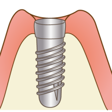 インプラント埋入（一次手術）