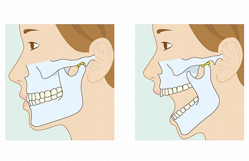 顎関節症