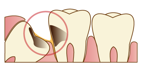 親知らずの抜歯対象