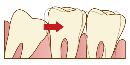 親知らずの抜歯対象