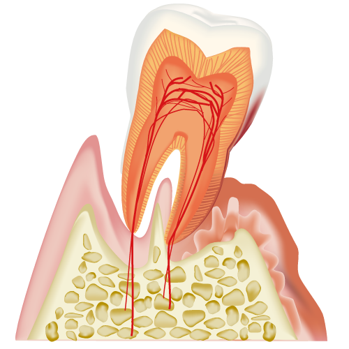 歯周炎（重度）