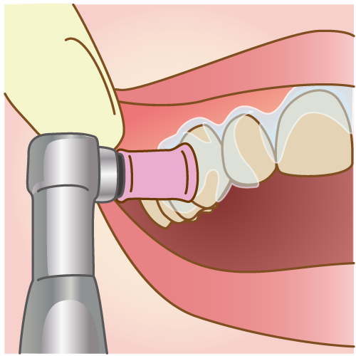 歯をクリーニングし、歯垢や歯石、着色を除去
